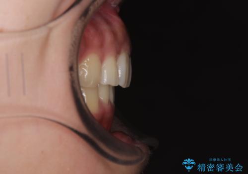 【モニター】唇が閉じにくい ワイヤー装置での抜歯矯正の治療後