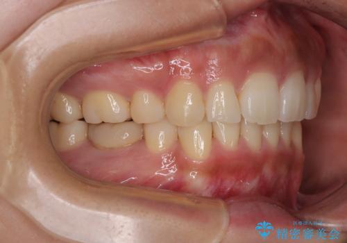 【モニター】唇が閉じにくい ワイヤー装置での抜歯矯正の治療後