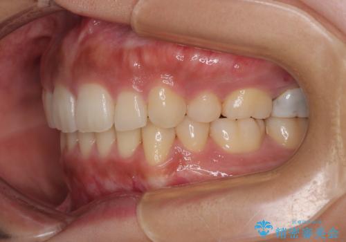 【モニター】唇が閉じにくい　ワイヤー装置での抜歯矯正の治療後