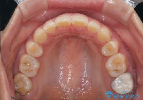 【モニター】唇が閉じにくい　ワイヤー装置での抜歯矯正の治療後