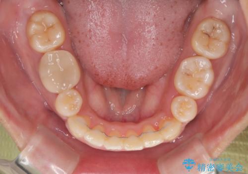 【モニター】唇が閉じにくい　ワイヤー装置での抜歯矯正の治療後