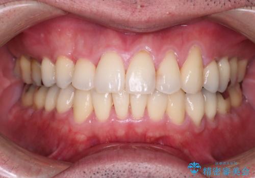 【メタル装置】1本のみ抜歯してワイヤー矯正の症例 治療後