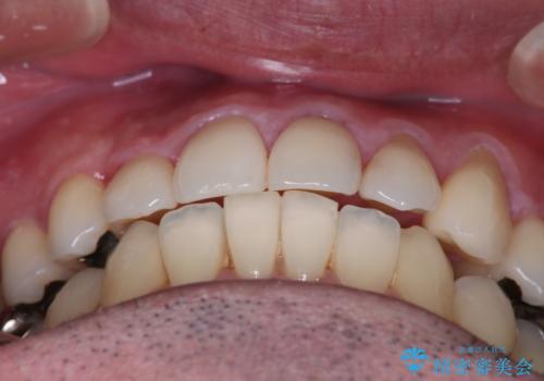 【メタル装置】1本のみ抜歯してワイヤー矯正の治療後