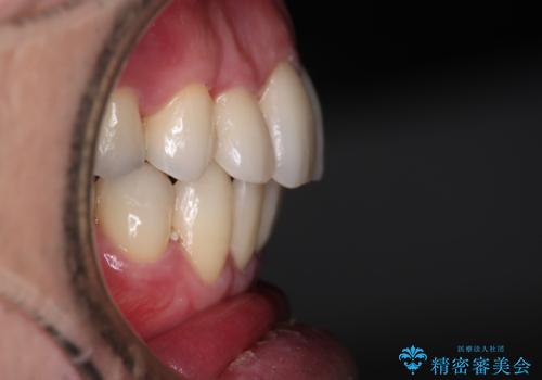 【メタル装置】1本のみ抜歯してワイヤー矯正の治療後