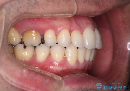 【メタル装置】1本のみ抜歯してワイヤー矯正の治療後