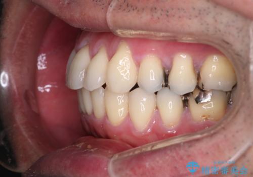 【メタル装置】1本のみ抜歯してワイヤー矯正の治療後