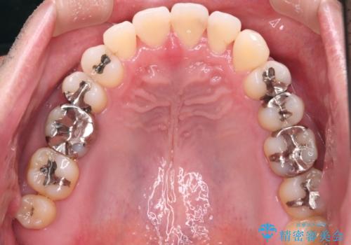 【メタル装置】1本のみ抜歯してワイヤー矯正の治療後