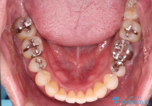 【メタル装置】1本のみ抜歯してワイヤー矯正の治療後