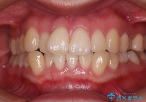 矯正治療前に歯を白くしたい!の症例 治療前