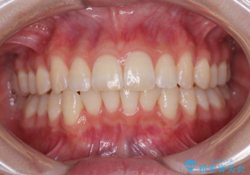 気になる前歯と咬み合わせを改善 インビザライン・モデレートの治療中