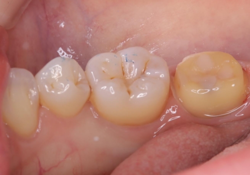 【セラミッククラウン】【生活歯髄療法】歯に穴が空いているの治療中