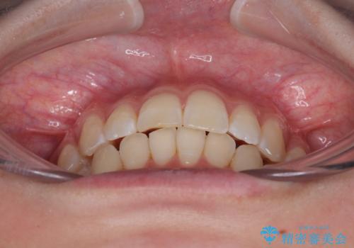 気になる前歯と咬み合わせを改善 インビザライン・モデレートの治療中