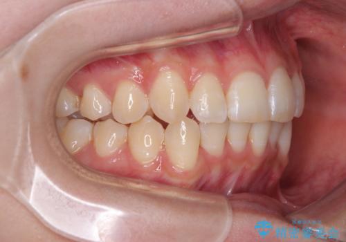 気になる前歯と咬み合わせを改善 インビザライン・モデレートの治療中