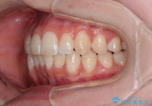 気になる前歯と咬み合わせを改善　インビザライン・モデレートの治療中
