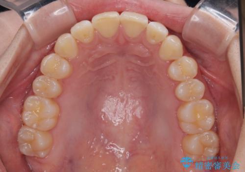 気になる前歯と咬み合わせを改善 インビザライン・モデレートの治療中