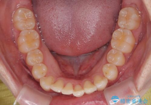 気になる前歯と咬み合わせを改善　インビザライン・モデレートの治療中