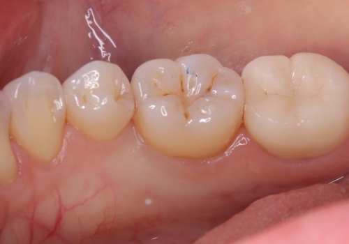 【セラミッククラウン】【生活歯髄療法】歯に穴が空いているの治療後