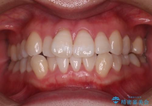 矯正治療前に歯を白くしたい!の治療後