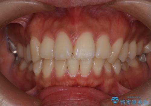 口元の突出感を解消し、横顔を美しく整えるワイヤー矯正の治療前