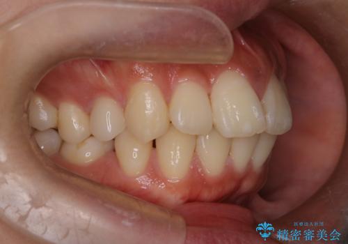 口元の突出感を解消し、横顔を美しく整えるワイヤー矯正の治療前