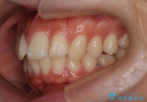 口元の突出感を解消し、横顔を美しく整えるワイヤー矯正の治療前