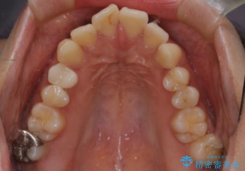 口元の突出感を解消し、横顔を美しく整えるワイヤー矯正の治療前