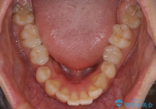 口元の突出感を解消し、横顔を美しく整えるワイヤー矯正の治療前