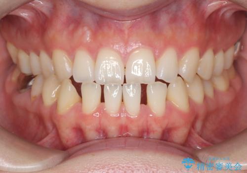 すきっ歯・切端咬合・空隙歯列|インビザラインで11ヵ月で治療完了の症例 治療前