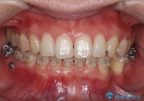 矯正中も清潔な口元への症例 治療前