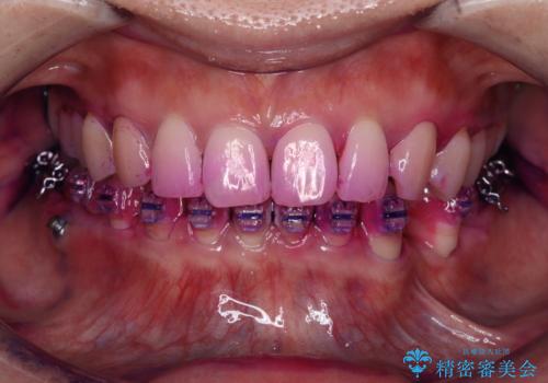 矯正中も清潔な口元への治療中