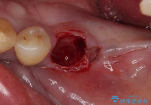 割れて揺れている奥歯　抜歯即時・早期埋入インプラント治療の治療前