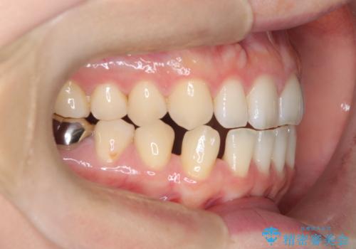 すきっ歯・切端咬合・空隙歯列|インビザラインで11ヵ月で治療完了の治療前