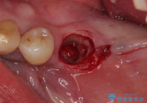 割れて揺れている奥歯 抜歯即時・早期埋入インプラント治療の治療中