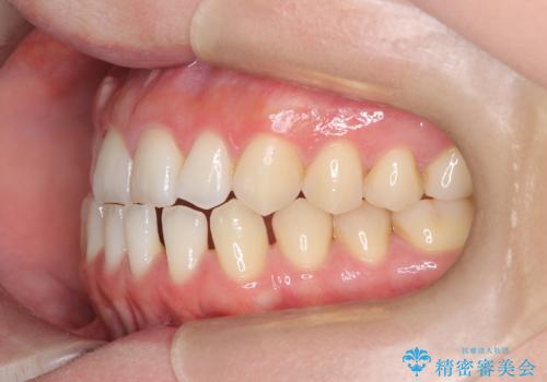 すきっ歯・切端咬合・空隙歯列|インビザラインで11ヵ月で治療完了の治療前