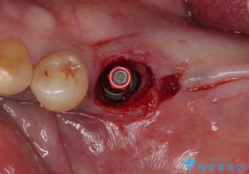 割れて揺れている奥歯 抜歯即時・早期埋入インプラント治療の治療後