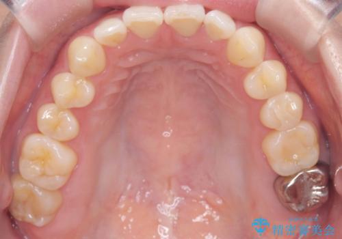 すきっ歯・切端咬合・空隙歯列|インビザラインで11ヵ月で治療完了の治療前