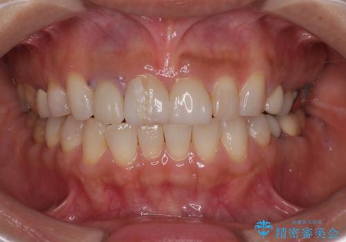 適合不良のラミネートベニアをやり替えて自然な笑顔に|オールセラミッククラウンによる前歯補綴症例の症例 治療前