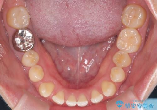 すきっ歯・切端咬合・空隙歯列|インビザラインで11ヵ月で治療完了の治療前