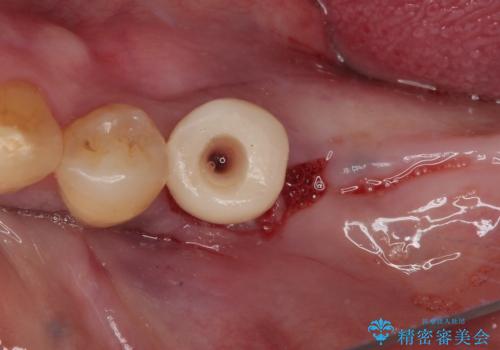 割れて揺れている奥歯　抜歯即時・早期埋入インプラント治療の治療前