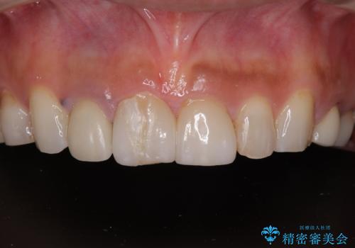 適合不良のラミネートベニアをやり替えて自然な笑顔に|オールセラミッククラウンによる前歯補綴症例の治療前