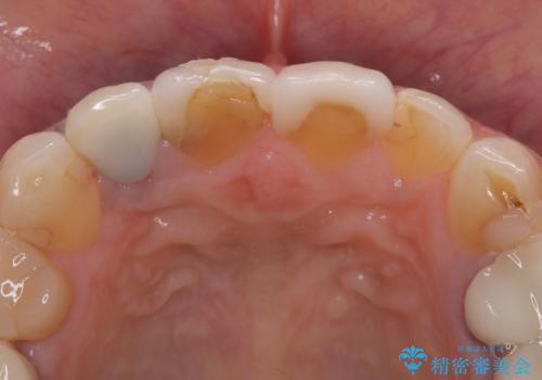 適合不良のラミネートベニアをやり替えて自然な笑顔に|オールセラミッククラウンによる前歯補綴症例の治療前