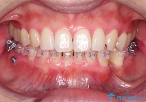 矯正中も清潔な口元への治療後
