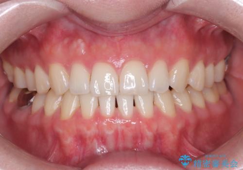 すきっ歯・切端咬合・空隙歯列|インビザラインで11ヵ月で治療完了の症例 治療後