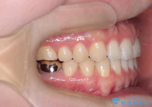 すきっ歯・切端咬合・空隙歯列|インビザラインで11ヵ月で治療完了の治療後