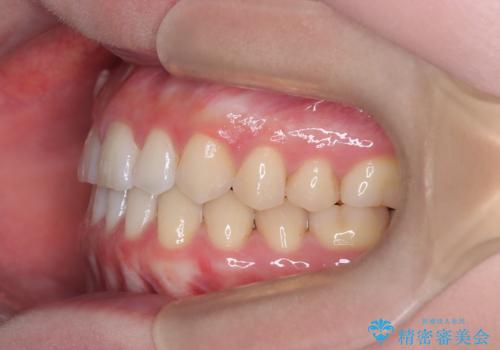 すきっ歯・切端咬合・空隙歯列|インビザラインで11ヵ月で治療完了の治療後