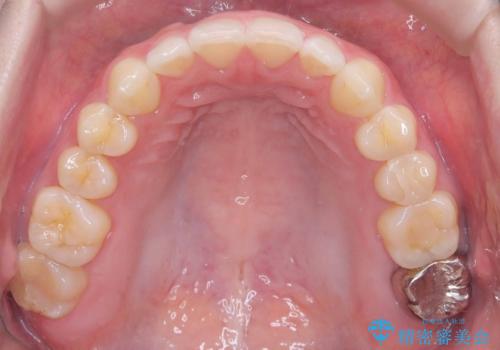 すきっ歯・切端咬合・空隙歯列|インビザラインで11ヵ月で治療完了の治療後