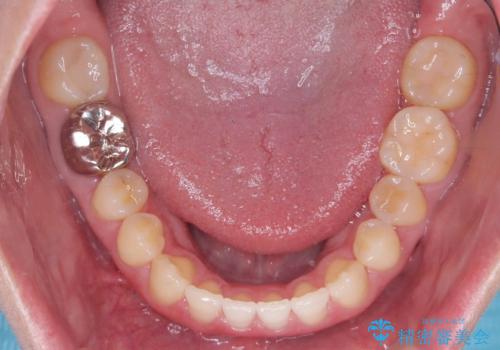 すきっ歯・切端咬合・空隙歯列|インビザラインで11ヵ月で治療完了の治療後