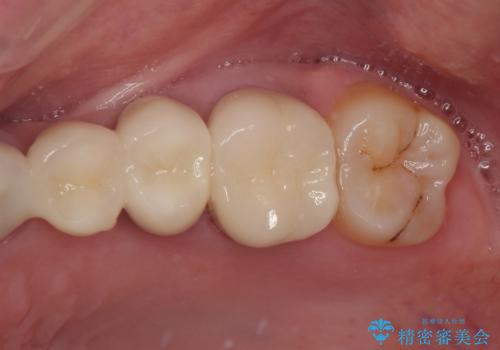 奥歯がしみる　オールセラミッククラウンによる奥歯のむし歯治療の治療後