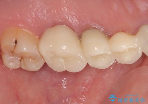 奥歯がしみる オールセラミッククラウンによる奥歯のむし歯治療の治療後
