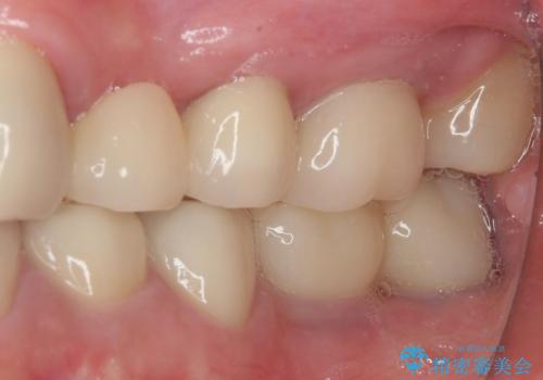 奥歯がしみる　オールセラミッククラウンによる奥歯のむし歯治療の治療後